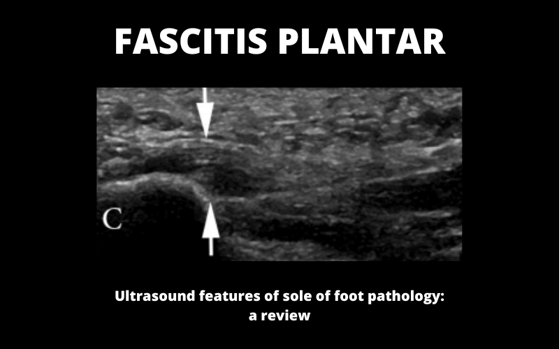 Fascia Plantar Ecografía Aprende A Valorarla Tempo Formación 5120